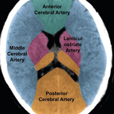 acute CT head